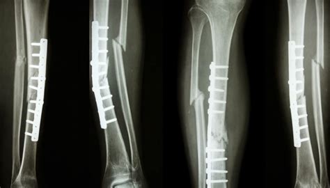 metal implants for bone healing